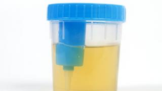 Proteinuria or protein in the urine as a sign of kidney disease